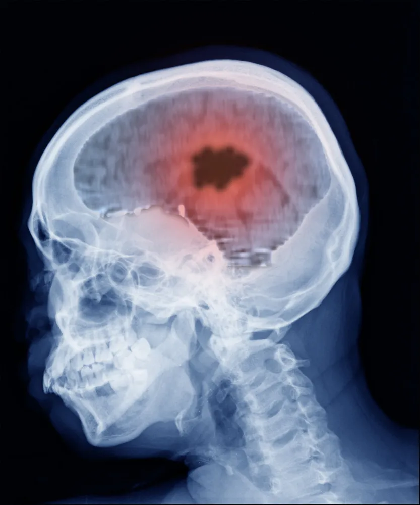Ilustração de um tumor cerebral crescendo e pressionando o tecido neural ao redor.