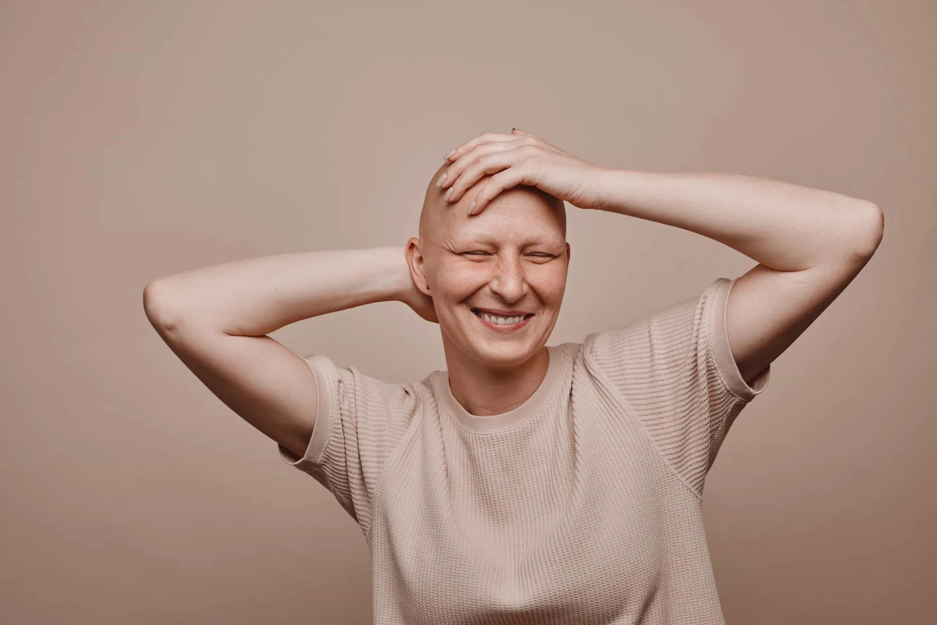 Mulher com a cabeça completamente sem cabelos, representando a alopecia universalis.
