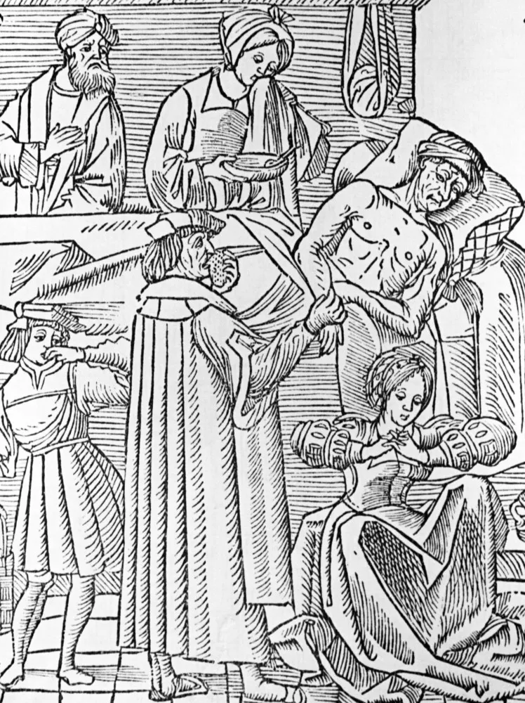 Ilustração médica mostrando os bubões, inchaços dolorosos causados pela peste bubônica.