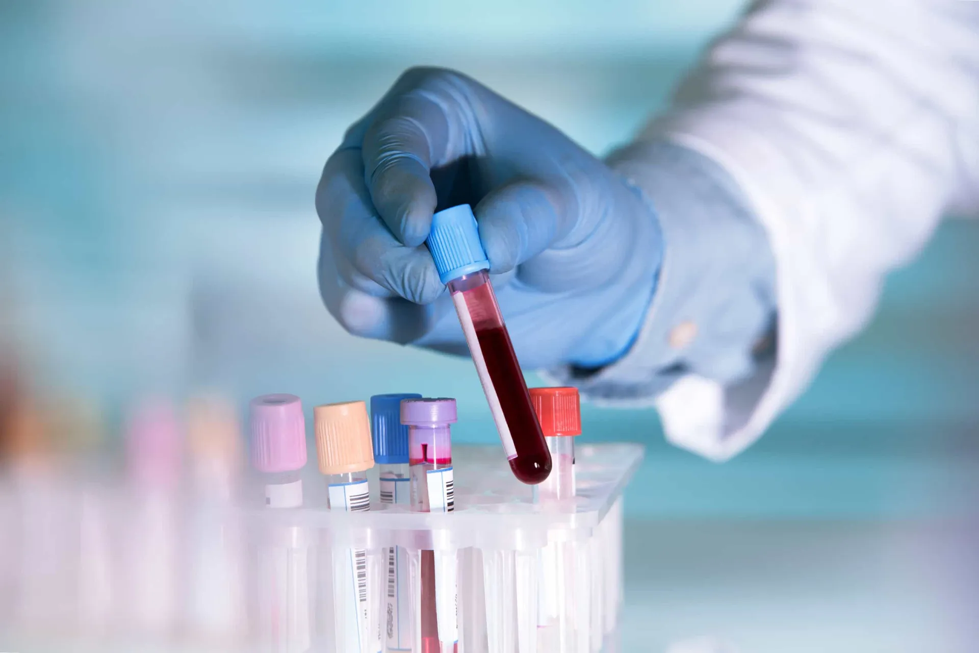 Tubo de exame de sangue, ferramenta chave para confirmar a Síndrome de Rett.