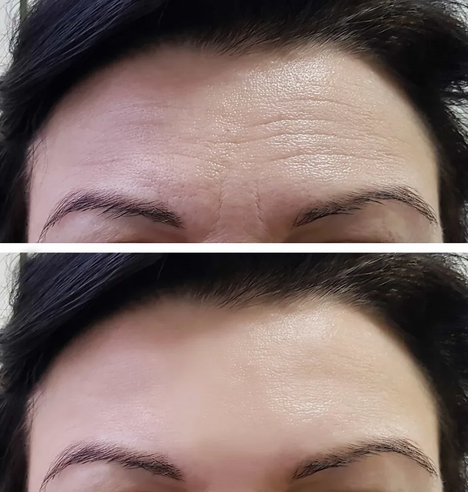 Mulher olhando o relógio com impaciência, esperando os resultados do Botox aparecerem.