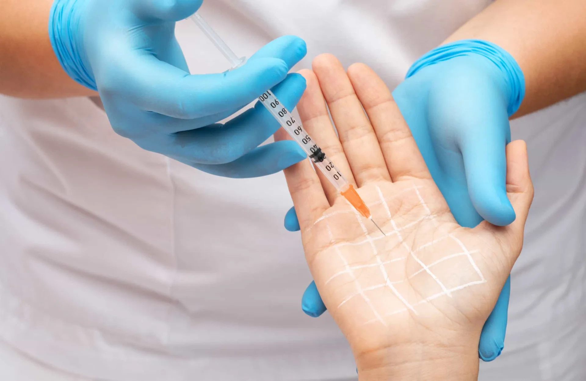 Ilustração mostrando a aplicação de Botox nas axilas para tratar a transpiração excessiva.