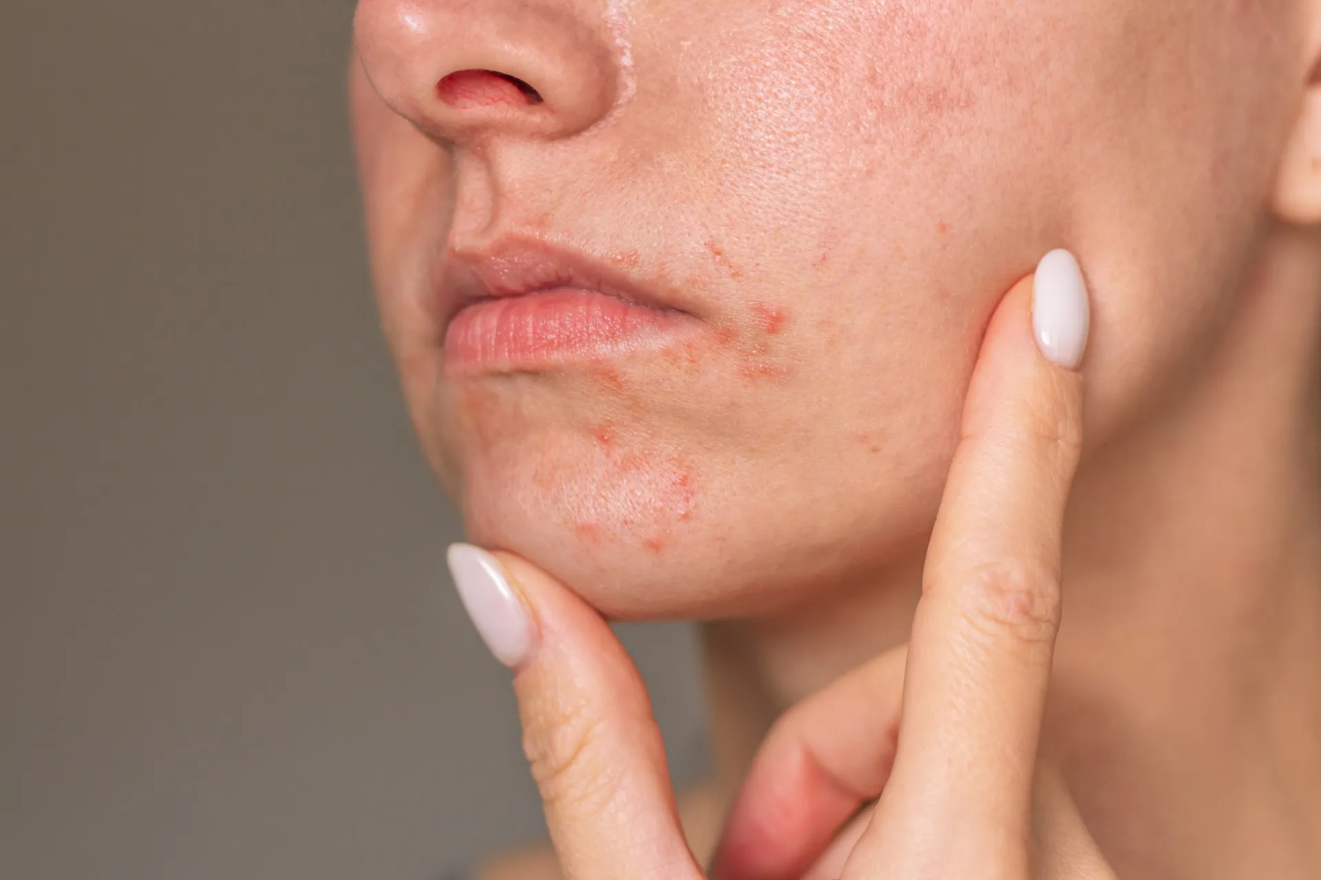 Uma pessoa aplicando um creme calmante em uma área da pele com vermelhidão e bolhas.