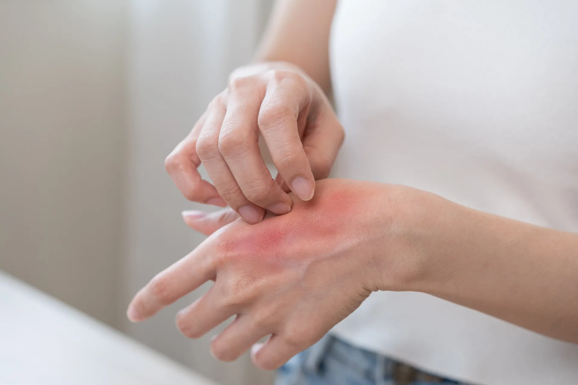 Uma mulher com a pele do rosto vermelha e irritada, demonstrando uma reação alérgica a cosméticos.