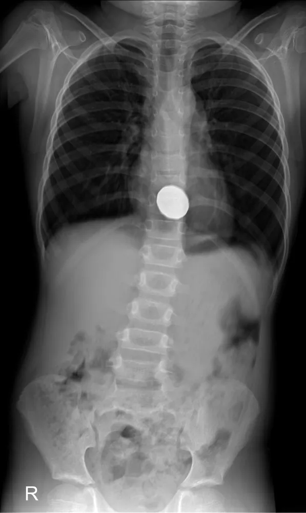 Diagrama mostrando o sistema digestivo humano, por onde um objeto engolido passaria.