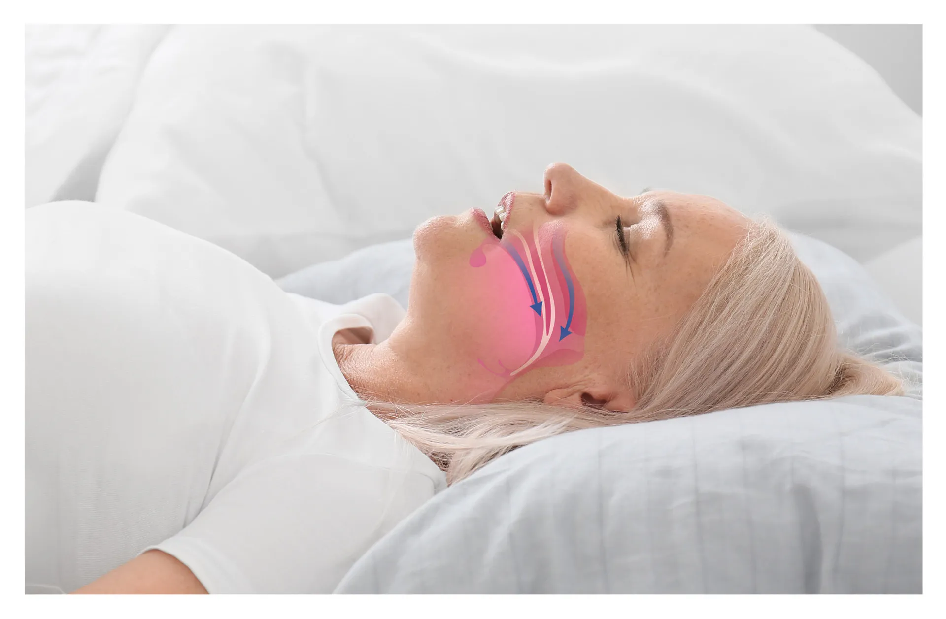 Mulher com expressão de desconforto devido a alergias ou congestão nasal.