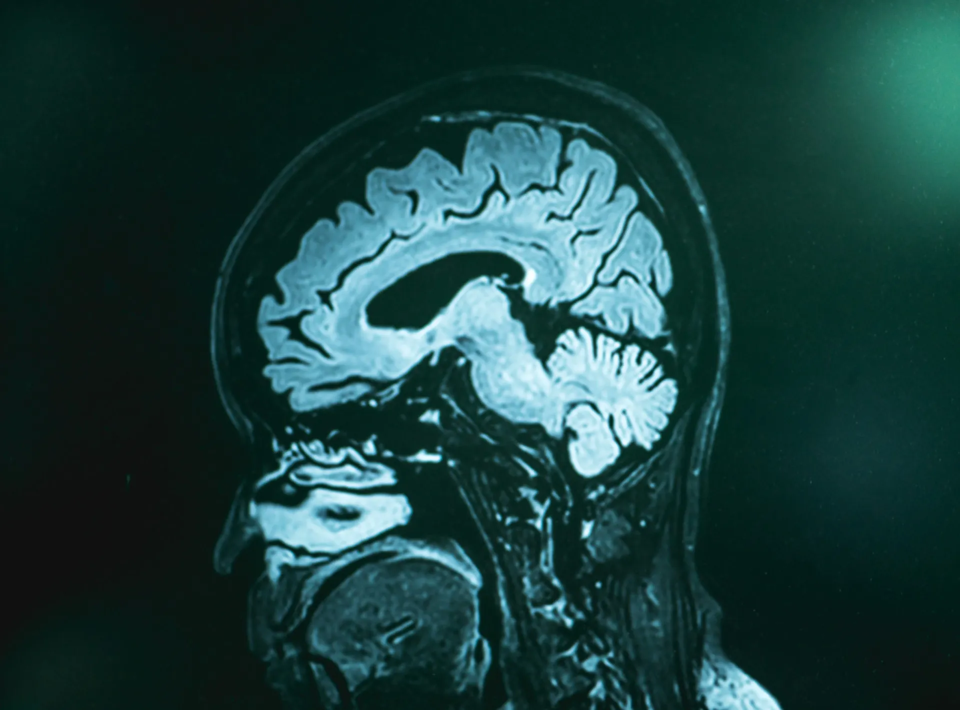 Ilustração de proteínas beta-amiloide se aglomerando e formando placas no cérebro, características do Alzheimer.