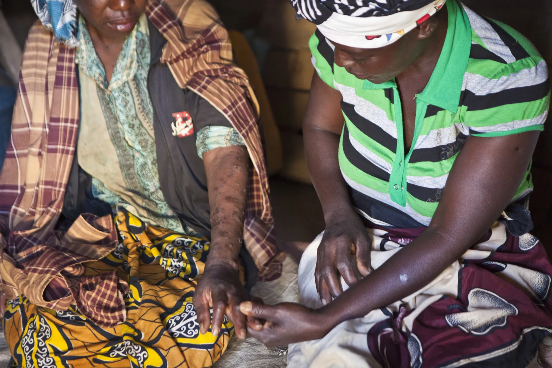 Mulher africana com uma condição de pele visível, representando os danos causados por produtos clareadores.