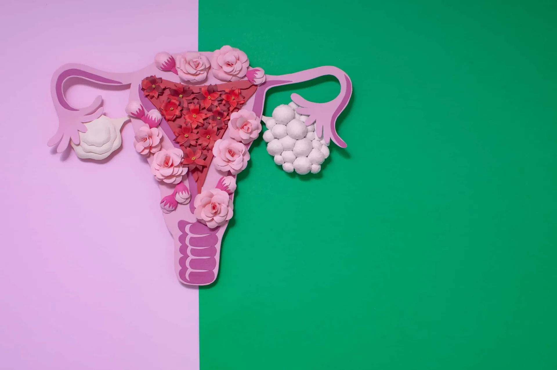Ilustração médica mostrando a anatomia dos ovários, um saudável e outro com cistos.