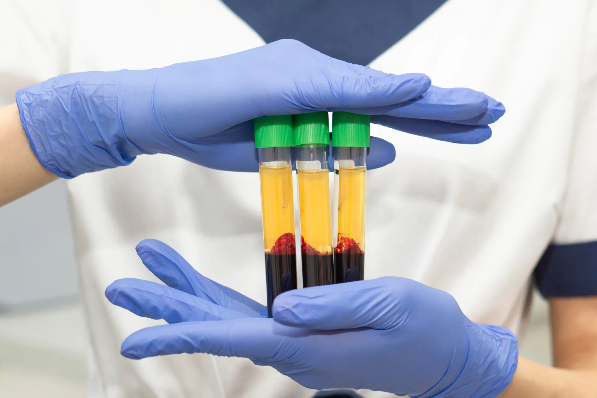 Profissional aplicando injeções de Plasma Rico em Plaquetas (PRP) no rosto de uma paciente.