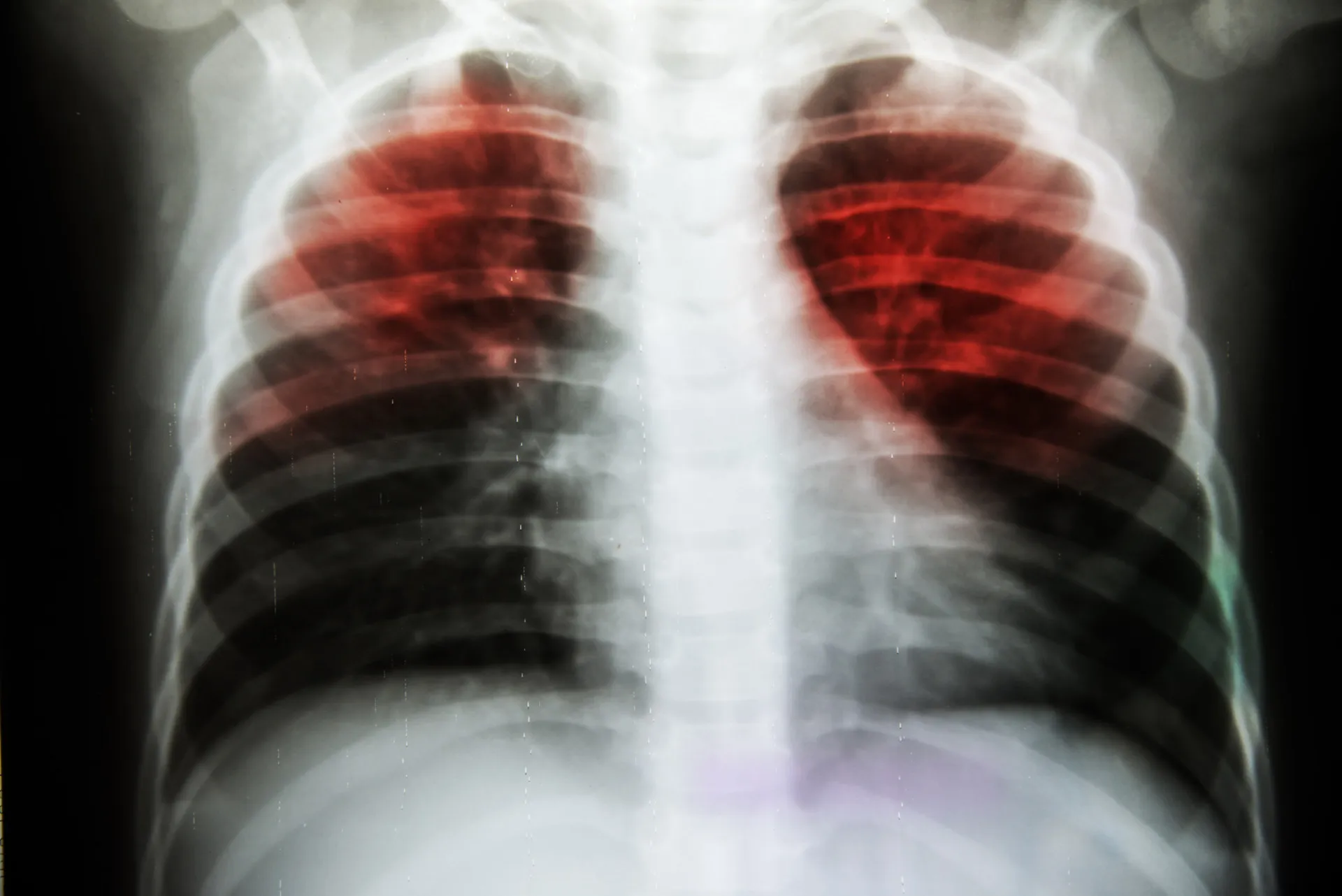 Microscopia de bactérias da tuberculose, uma das doenças que se torna mais difícil de tratar.