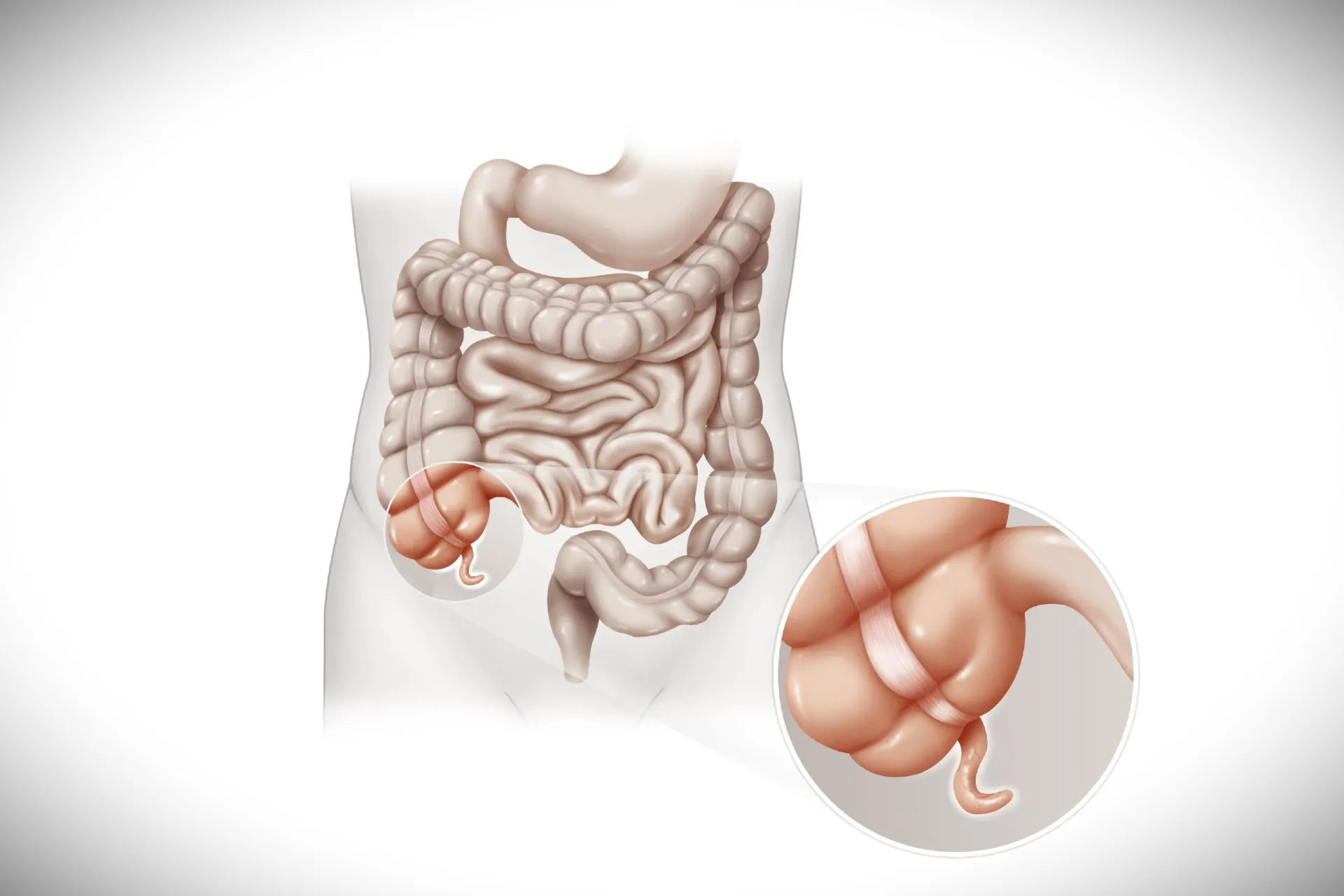 Ilustração médica detalhada do apêndice, um pequeno tubo ligado ao intestino grosso.