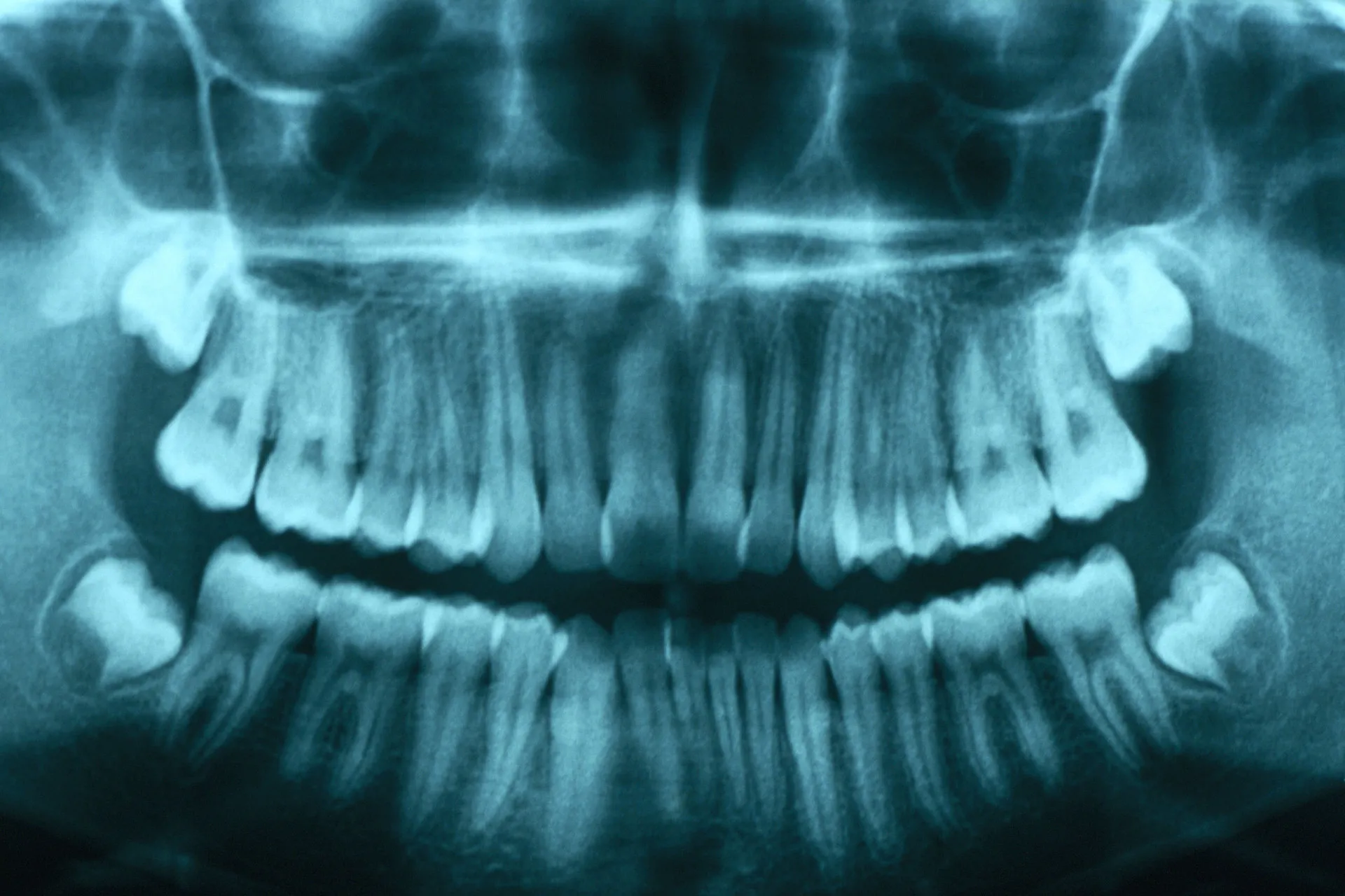 Raio-X de uma mandíbula humana mostrando os dentes do siso impactados.