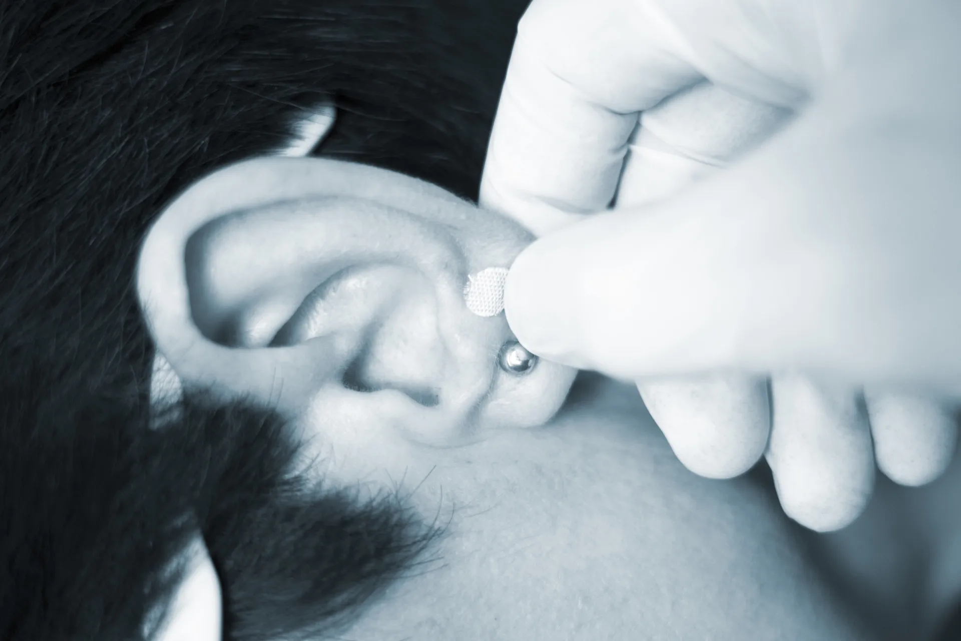 Semente de auriculoterapia firmemente presa à orelha com uma fita adesiva de cor de pele.